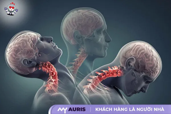 Xi măng sinh học giúp củng cố các đốt sống bị yếu do loãng xương hoặc bệnh lý