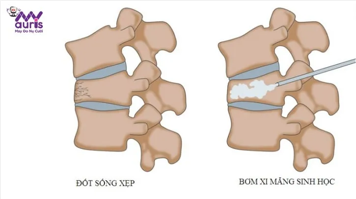 Chế độ sinh hoạt khoa học giúp kéo dài tuổi thọ của xi măng sinh học trong cơ thể