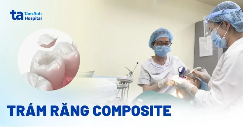 vật liệu trám răng composite